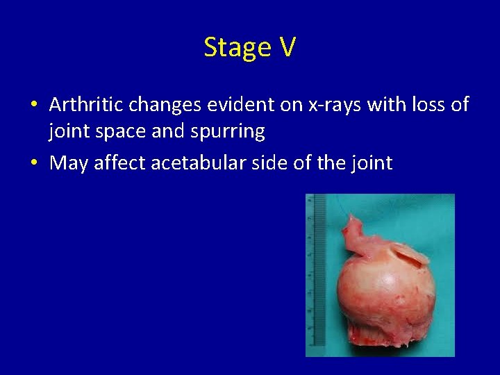 Stage V • Arthritic changes evident on x-rays with loss of joint space and