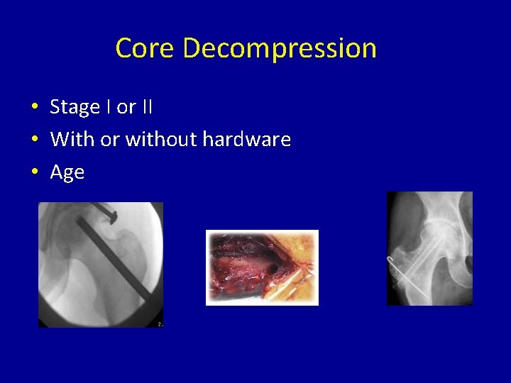 Core Decompression • Stage I or II • With or without hardware • Age