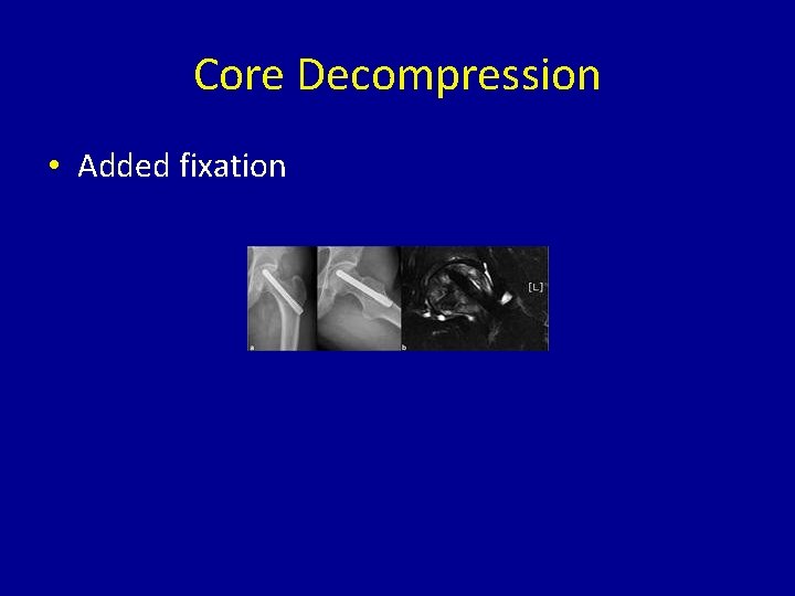 Core Decompression • Added fixation 