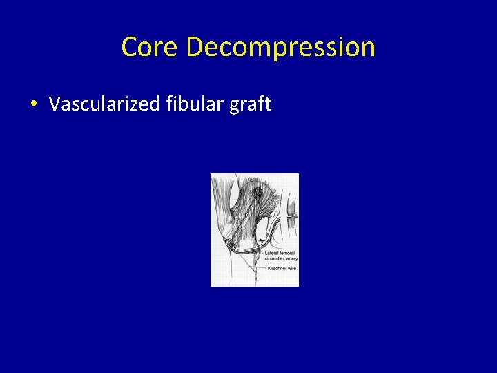 Core Decompression • Vascularized fibular graft 