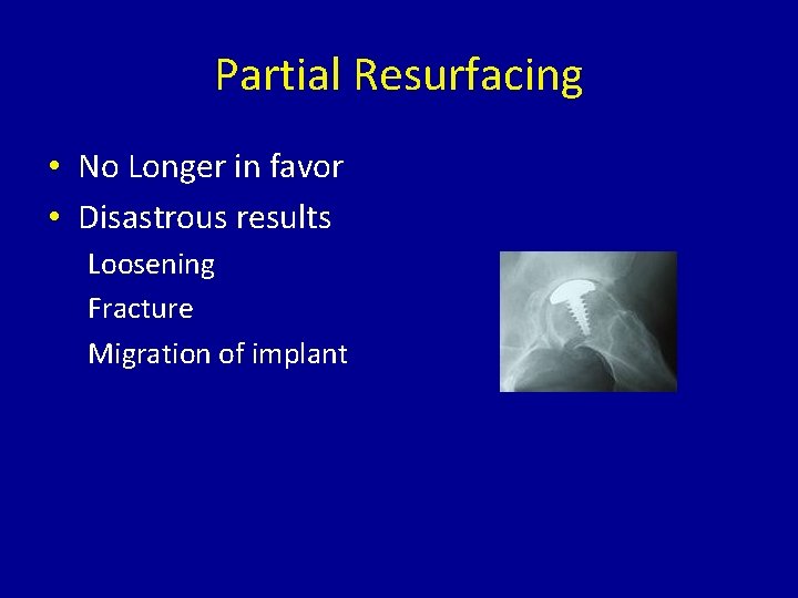 Partial Resurfacing • No Longer in favor • Disastrous results Loosening Fracture Migration of