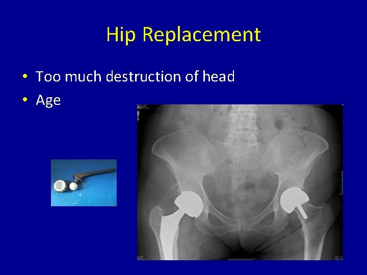 Hip Replacement • Too much destruction of head • Age 