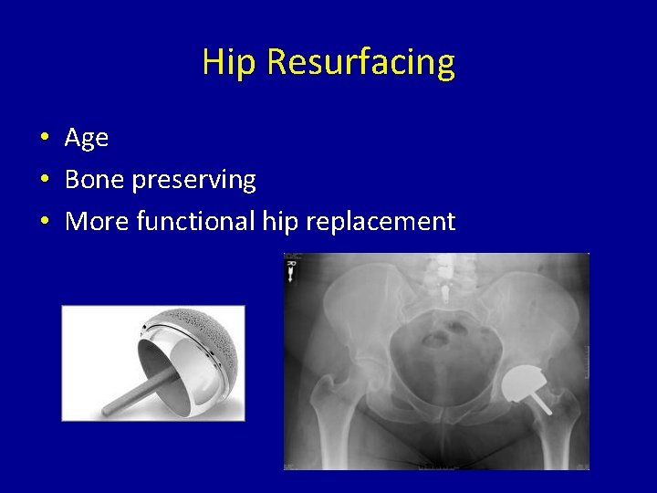 Hip Resurfacing • Age • Bone preserving • More functional hip replacement 