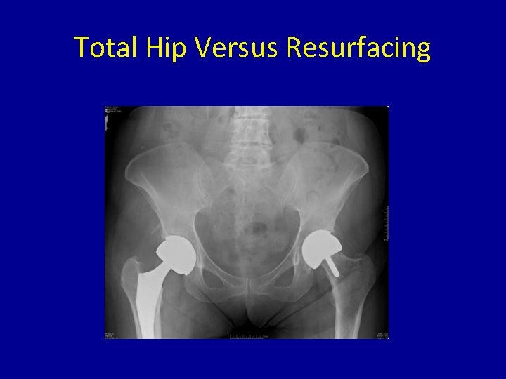 Total Hip Versus Resurfacing 