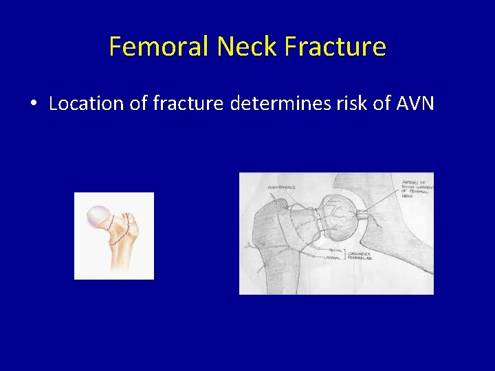 Femoral Neck Fracture • Location of fracture determines risk of AVN 