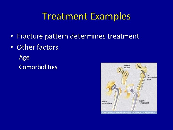Treatment Examples • Fracture pattern determines treatment • Other factors Age Comorbidities 