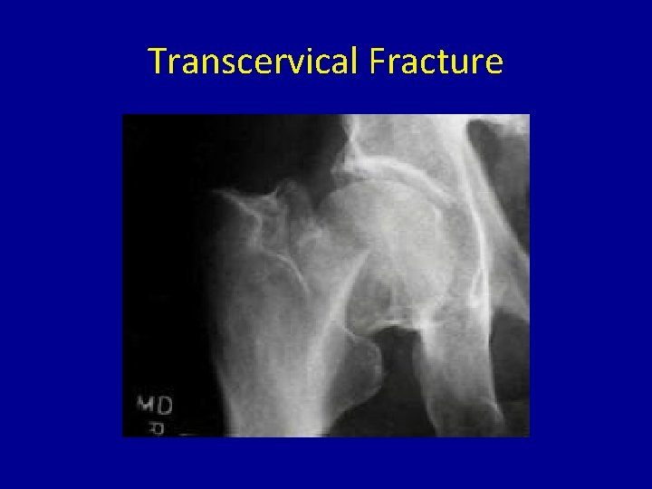 Transcervical Fracture 