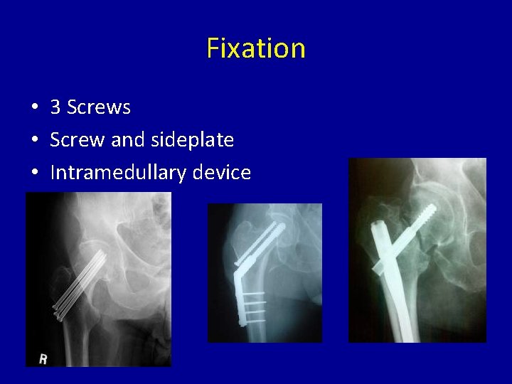 Fixation • 3 Screws • Screw and sideplate • Intramedullary device 