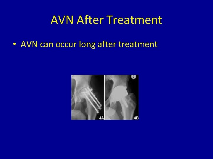 AVN After Treatment • AVN can occur long after treatment 