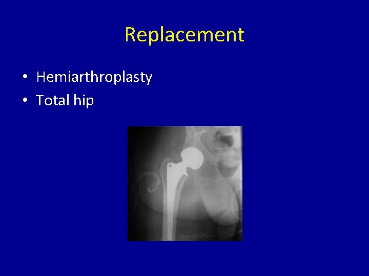 Replacement • Hemiarthroplasty • Total hip 