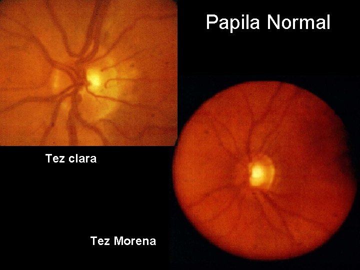 Papila Normal Tez clara Tez Morena 