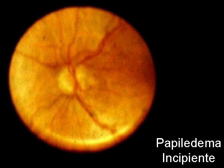 Papiledema Incipiente 