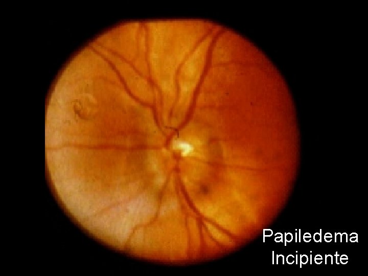 Papiledema Incipiente 