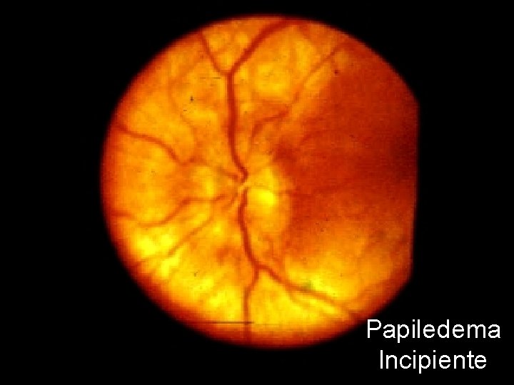 Papiledema Incipiente 