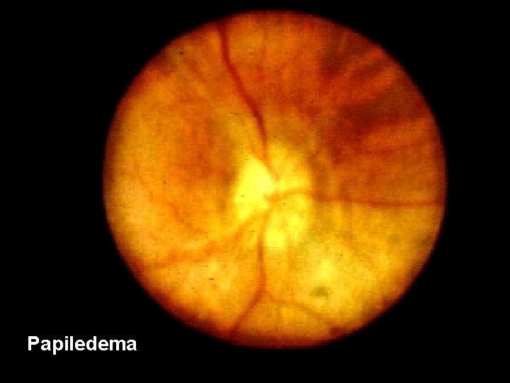 Papiledema 