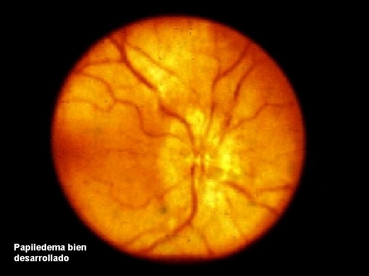 Papiledema bien desarrollado 