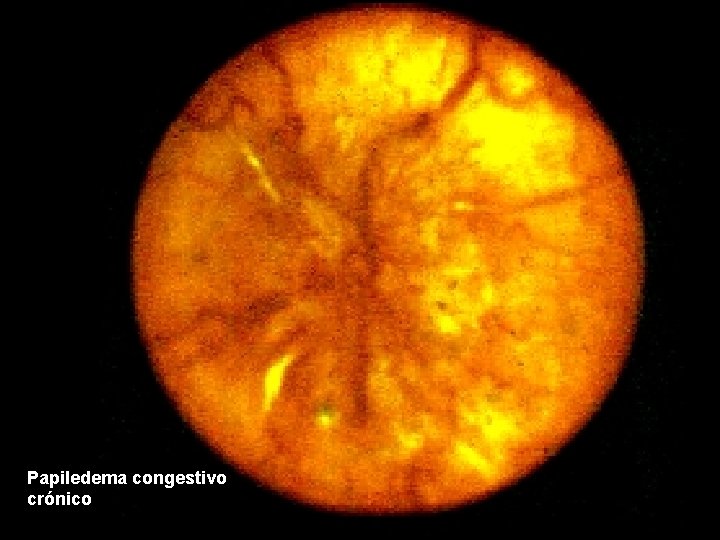 Papiledema congestivo crónico 