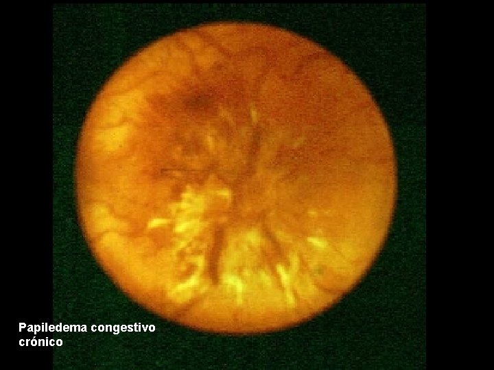 Papiledema congestivo crónico 