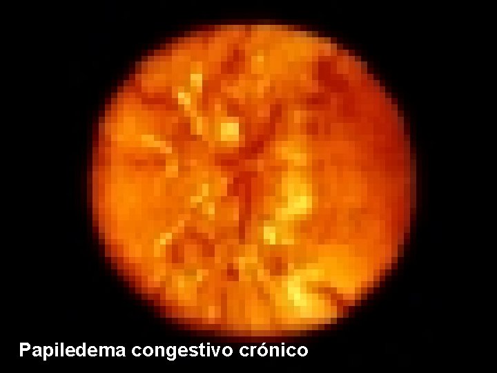 Papiledema congestivo crónico 