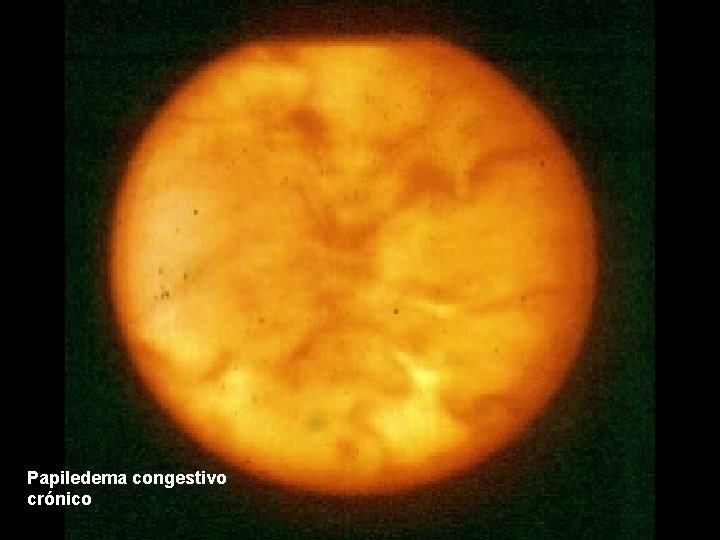 Papiledema congestivo crónico 