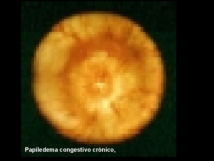 Papiledema congestivo crónico, 