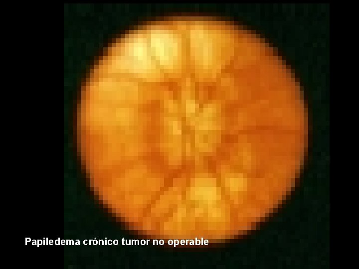 Papiledema crónico tumor no operable 