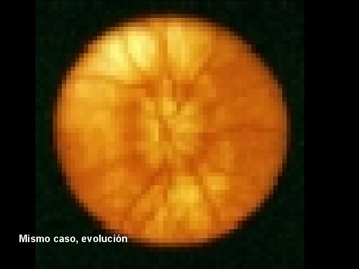 Mismo caso, evolución 
