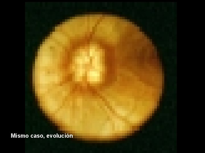 Mismo caso, evolución 