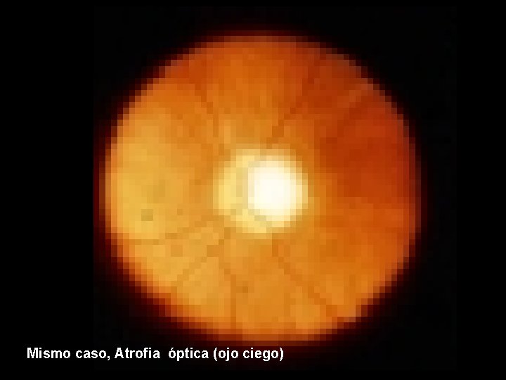 Mismo caso, Atrofia óptica (ojo ciego) 