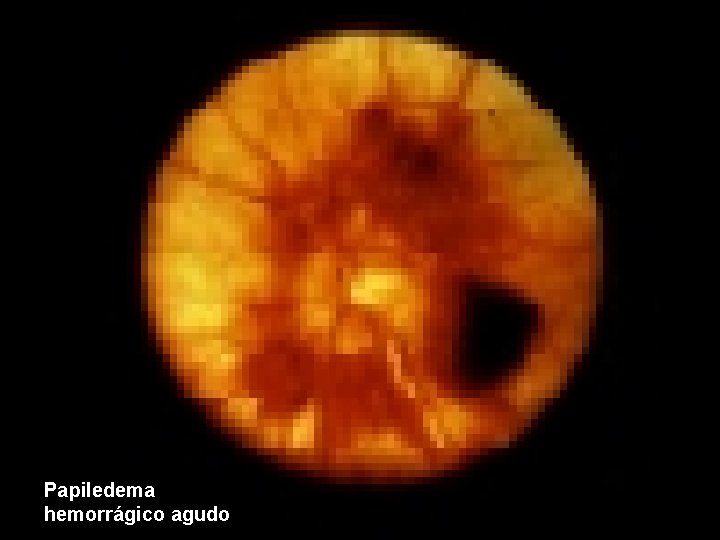 Papiledema hemorrágico agudo 