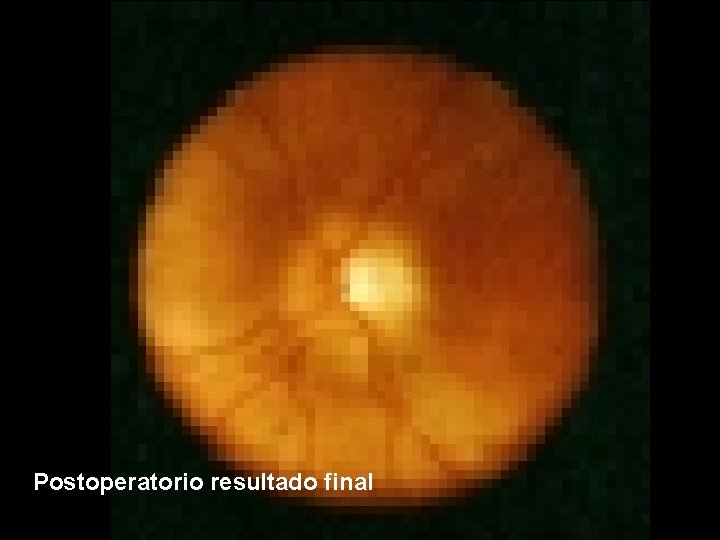 Postoperatorio resultado final 