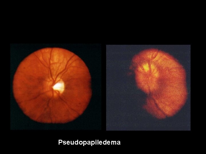 Pseudopapiledema 