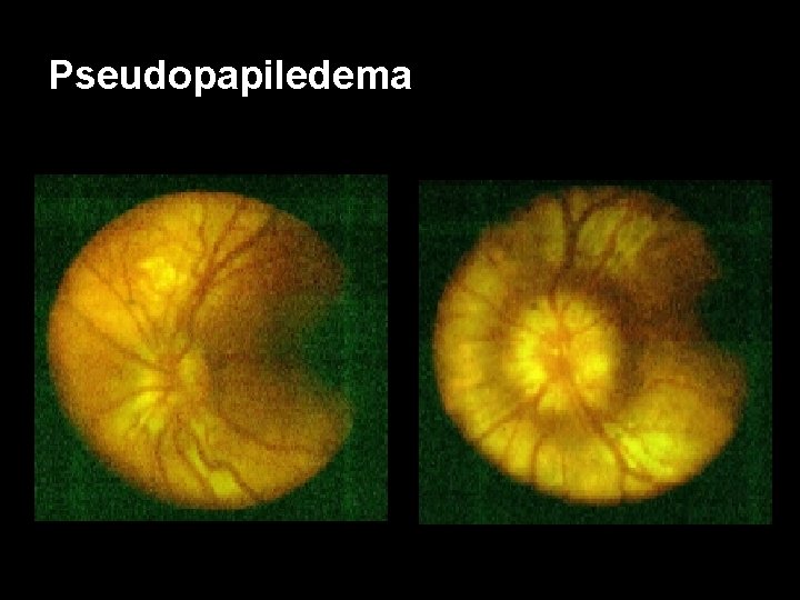 Pseudopapiledema 