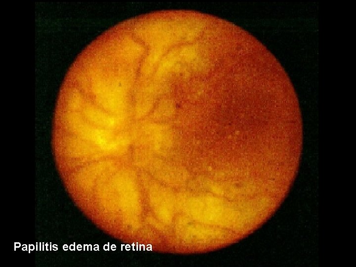 Papilitis edema de retina 