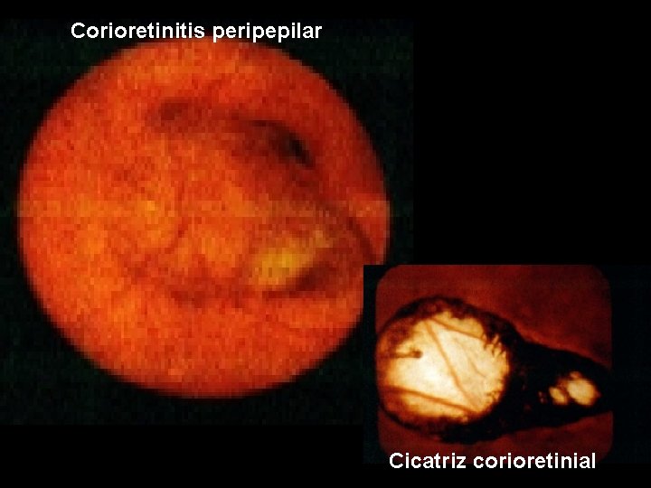 Corioretinitis peripepilar Cicatriz corioretinial 