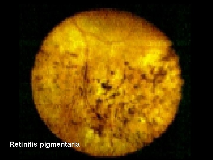 Retinitis pigmentaria 