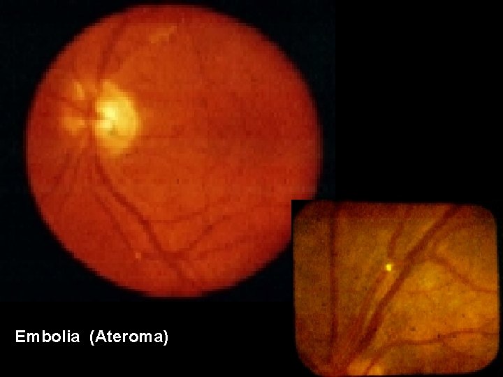 Embolia (Ateroma) 
