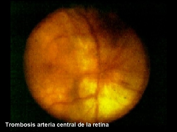 Trombosis arteria central de la retina 