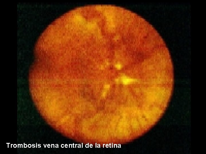 Trombosis vena central de la retina 