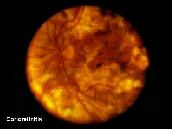 Corioretinitis 