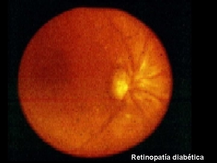 Retinopatía diabética 