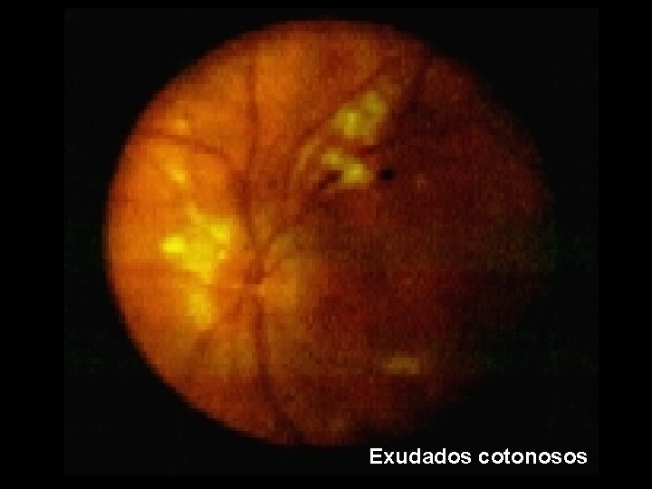 EXAMEN DEL FONDO DE OJO Exploracin Bsica Fundamental examen-del-fondo-de-ojo-exploracin-bsica-fundamental