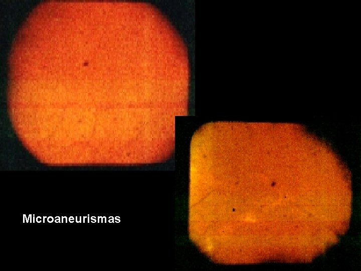 Microaneurismas 