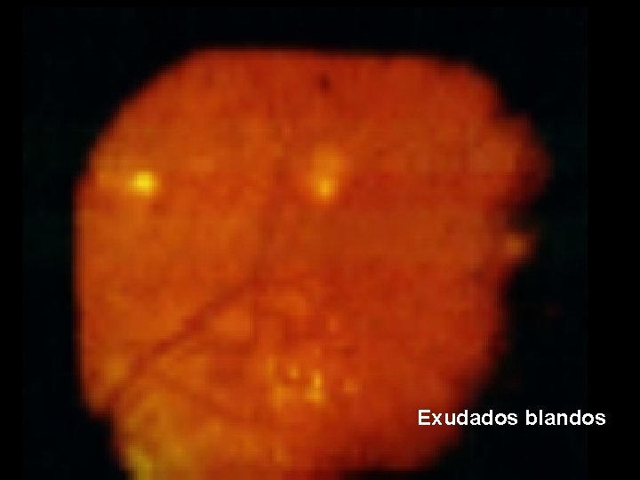 Exudados blandos 