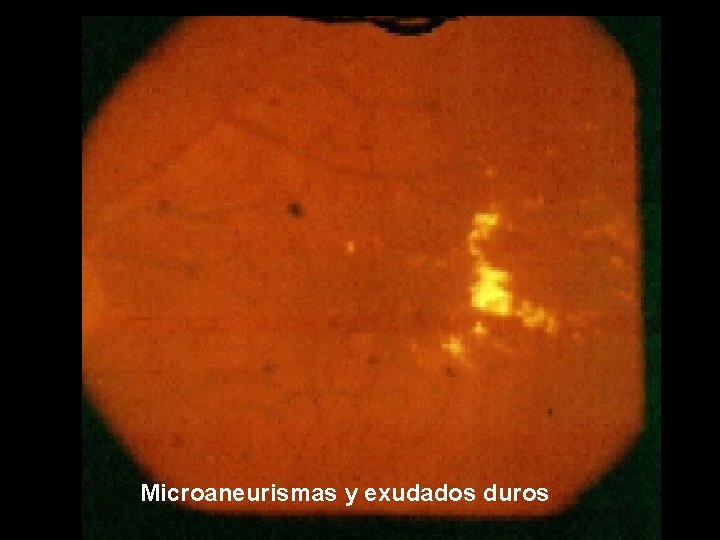 Microaneurismas y exudados duros 