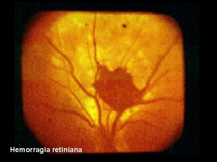 Hemorragia retiniana 