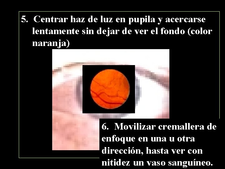 5. Centrar haz de luz en pupila y acercarse lentamente sin dejar de ver