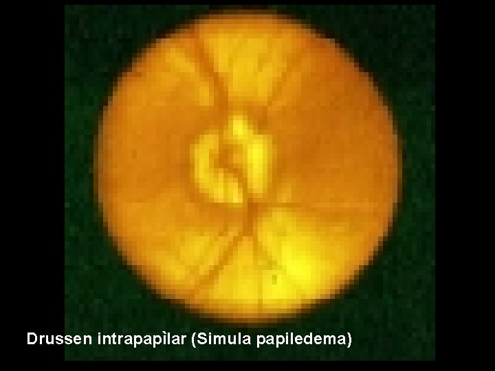 Drussen intrapapìlar (Simula papiledema) 