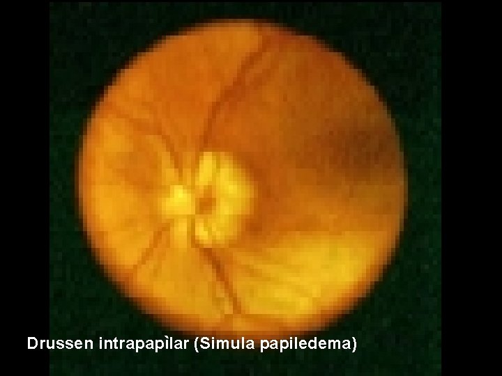 Drussen intrapapìlar (Simula papiledema) 