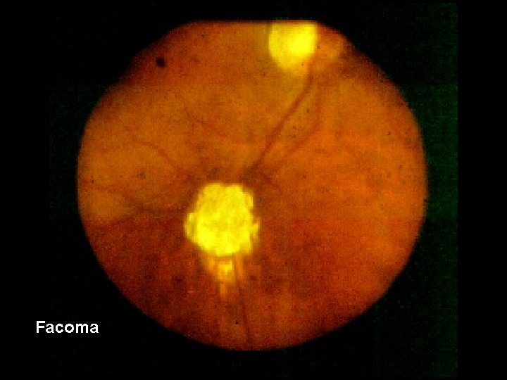 Facoma 